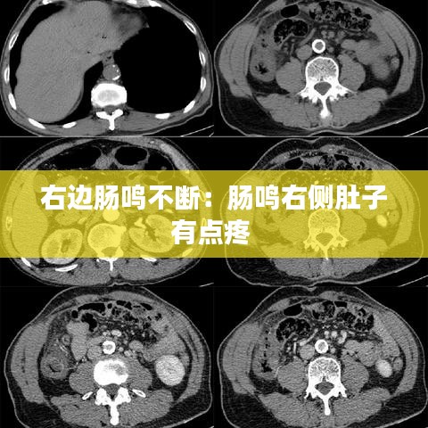 右邊腸鳴不斷：腸鳴右側(cè)肚子有點疼 