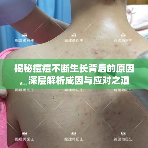 揭秘痘痘不斷生長背后的原因，深層解析成因與應(yīng)對之道