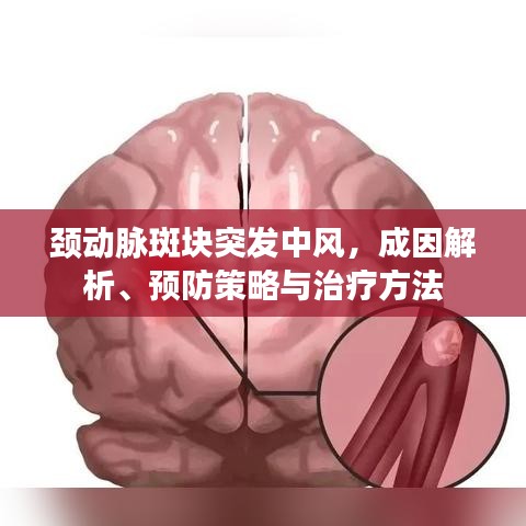 頸動脈斑塊突發(fā)中風(fēng)，成因解析、預(yù)防策略與治療方法